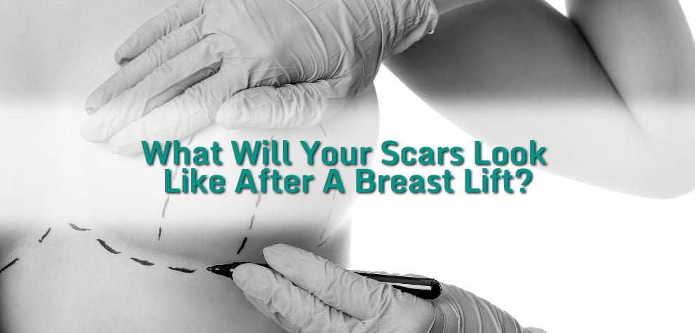 What will your scars look like after a breast lift?