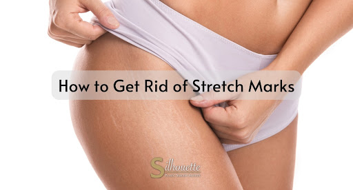 Can You Get Rid of Stretch Marks