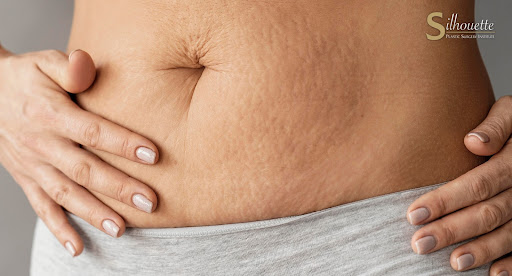 stretch marks removal