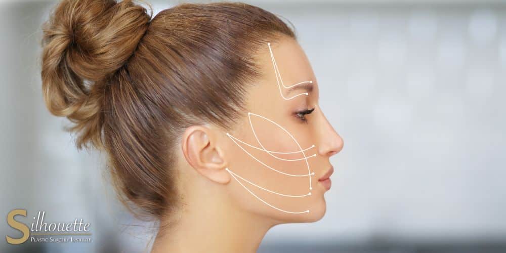 face lift without surgery