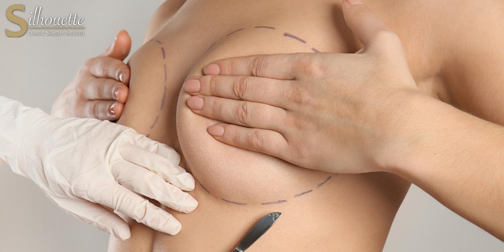 breast squamous cell carcinoma