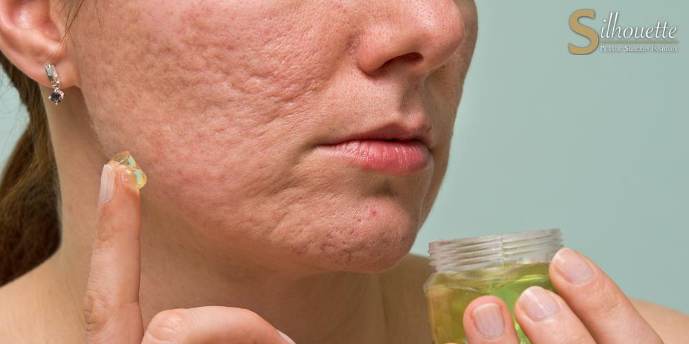 acne scar treatment