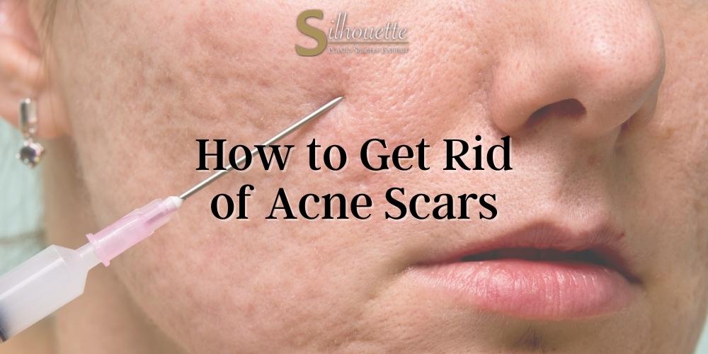 how to get rid of acne scars