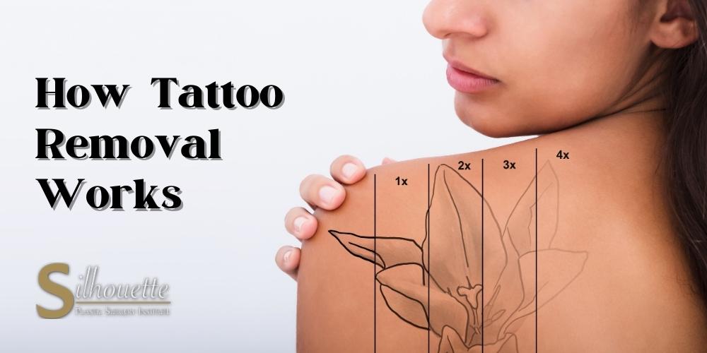 tattoo removal