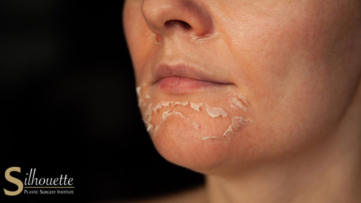 phenol chemical peels