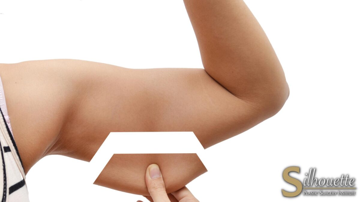 arm fat surgery