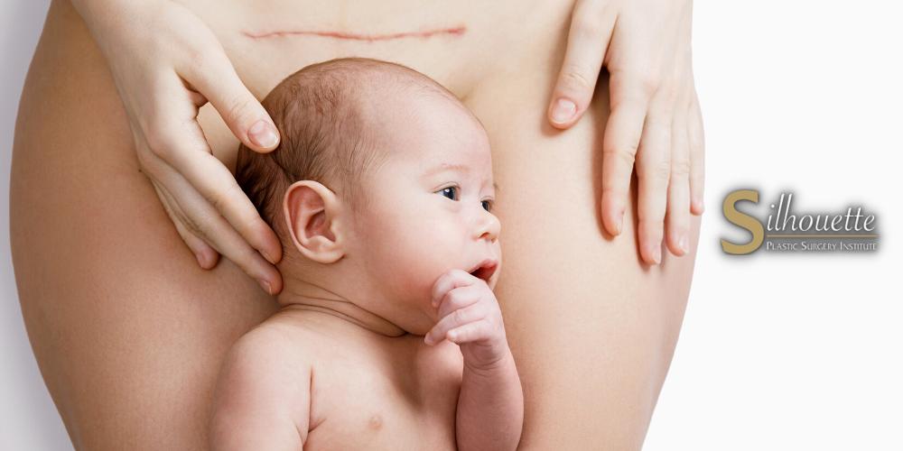 how soon can you get a bbl after giving birth