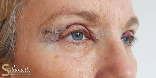 drooping eyelids treatment bakersfield