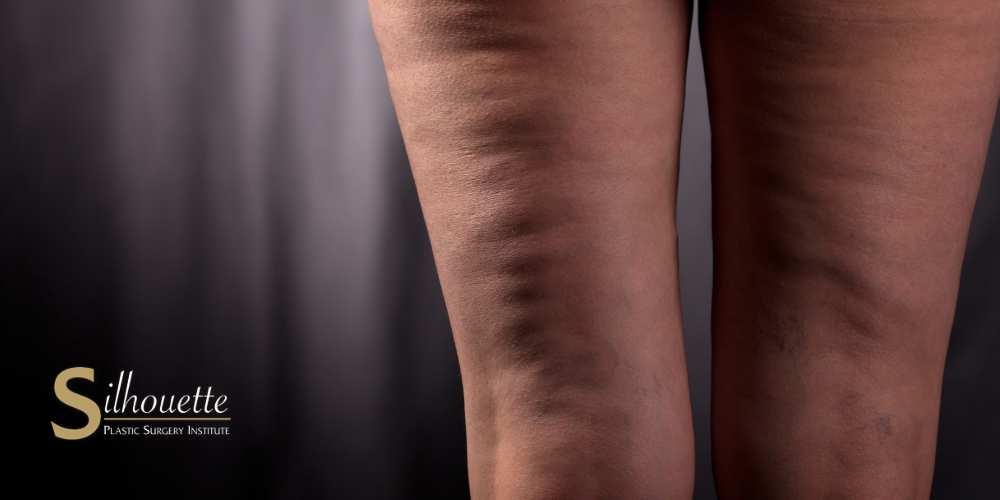 cellulite treatment in bakersfield, ca