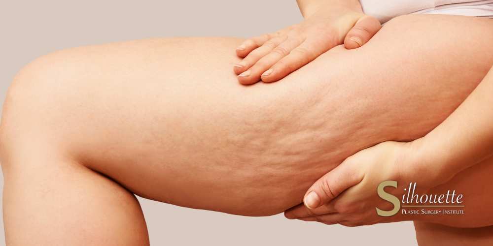 lipedema vs cellulite